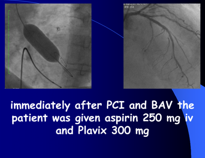 Case: Immediately after PCI and BAV the patient was given aspirin 250 mg iv and Plavix 300 mg