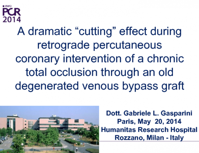 A dramatic “cutting” effect during retrograde percutaneous coronary intervention of a chronic total occlusion through an old degenerated venous bypass graft