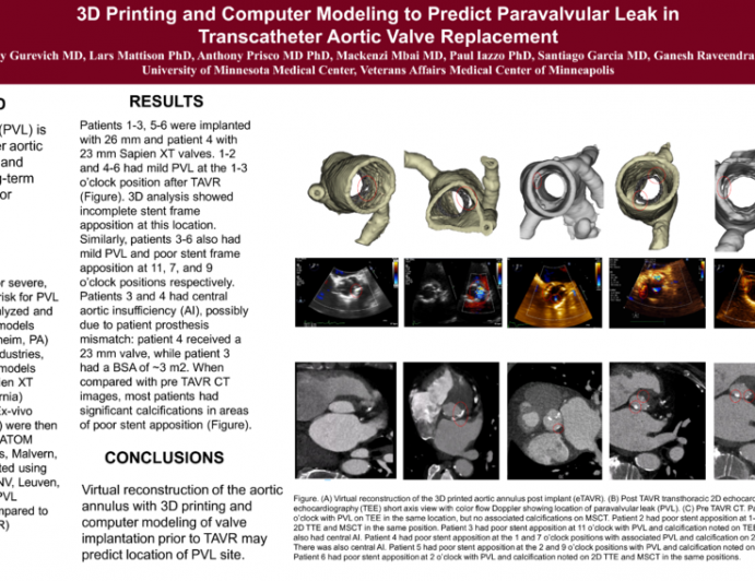 3D Printing and Computer Modeling to Predict Paravalvular Leak in Transcatheter Aortic Valve Replacement