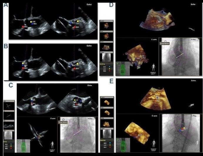 Echocardiographic Imaging for TAVR