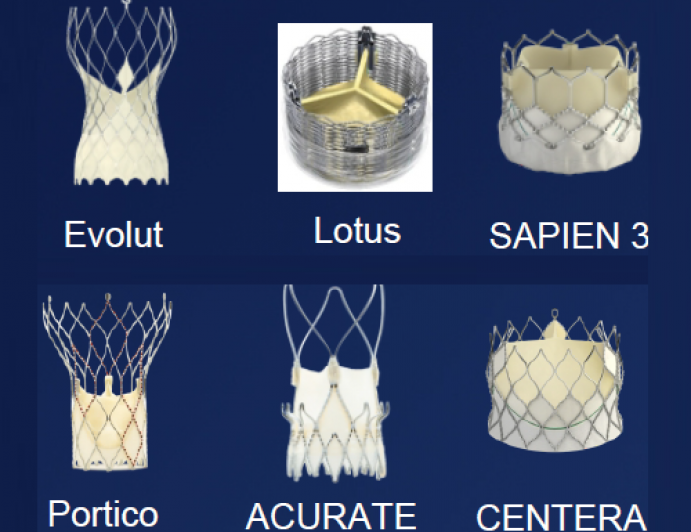 Modern “Era” TAVR with Optimal Technology and Techniques