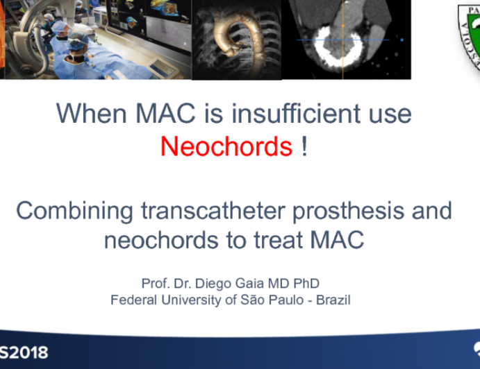 When MAC Is Insufficient, Use Neochords! The Combination of Transcatheter Prosthesis and Neochords to Treat MAC