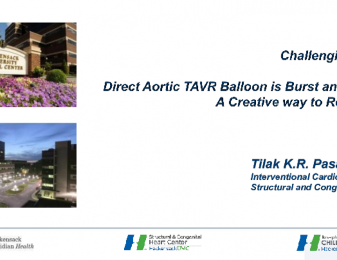 Direct Aortic TAVR Balloon Burst and Stuck! A Creative Way to Retrieve It