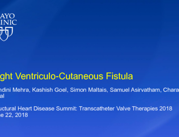 Right Ventriculocutaneous Fistula