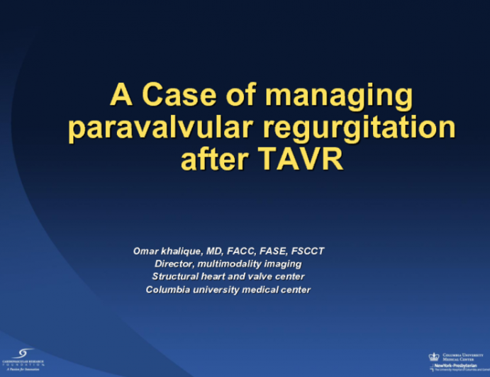 Case Presentation: A Case of Managing Paravalvular Regurgitation During TAVR