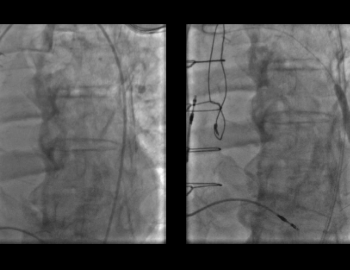 Wire Across: Native Coronary Perforation (Post CABG)
