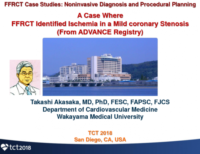 Case #3: A Case Where FFRCT Identified Ischemia in a Mild Coronary Stenosis (From the ADVANCE Registry)