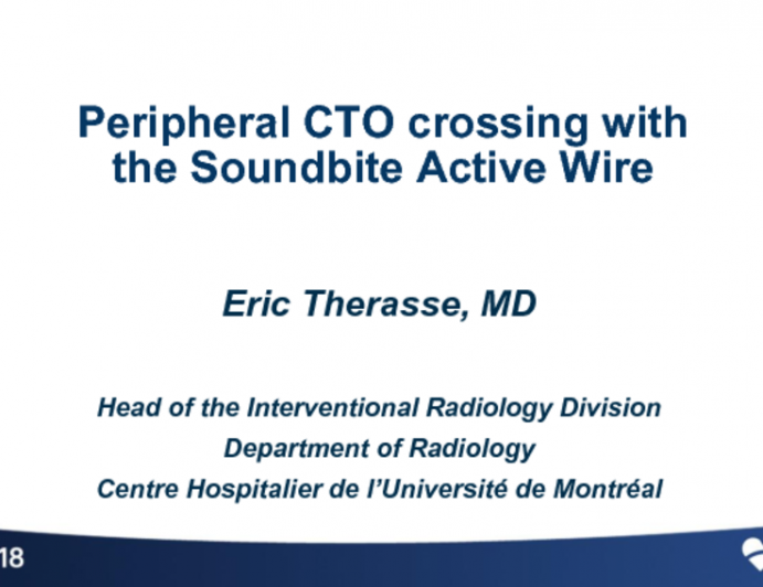 Peripheral CTO crossing with the SoundBite Active Wire (SoundBite)