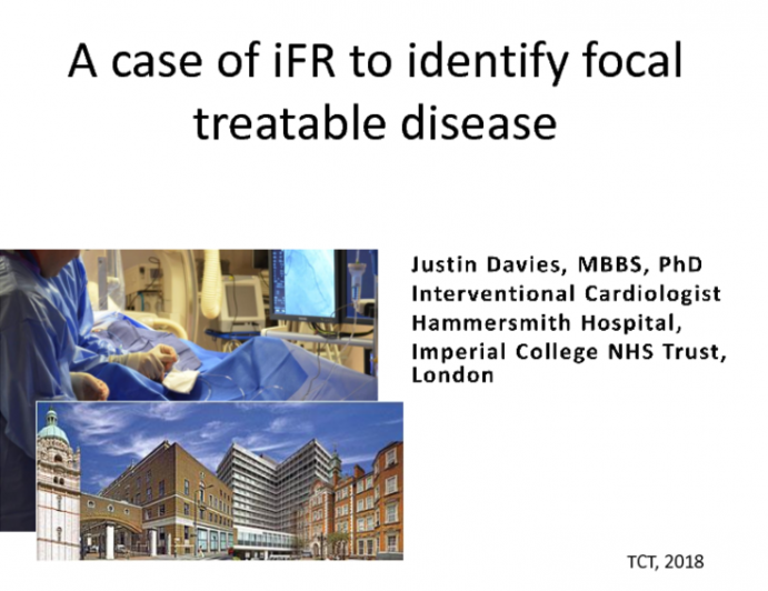Case #5: A Case of iFR Co-Registration To Identify Focal Treatable Disease