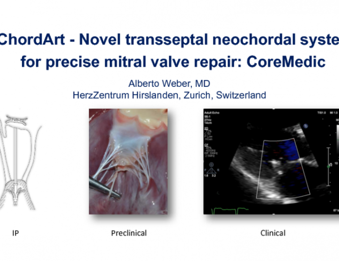 Novel Transseptal Neochordal System for Precise Mitral Valve Repair: Chordart