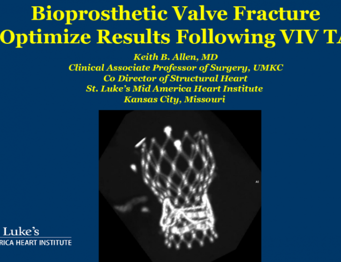 Case #3: A Case of Bioprosthetic Valve Fracture To Facilitate TAVR ViV