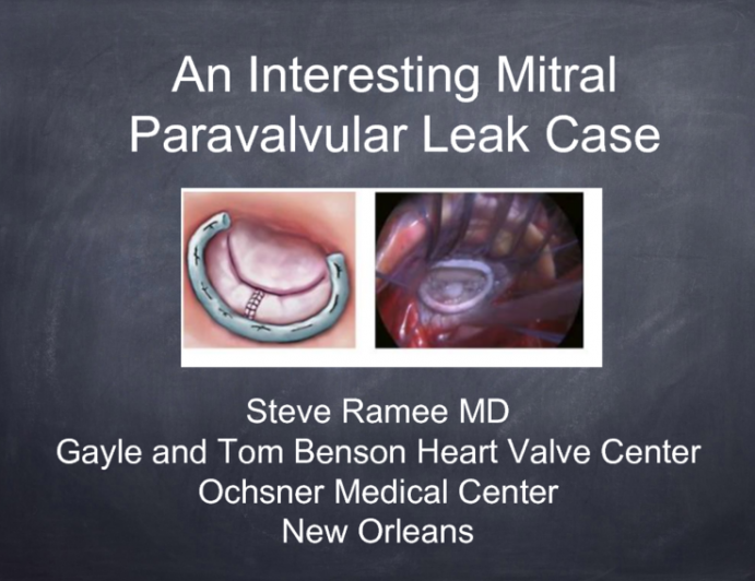 Case #4: A Complex Mitral Paravalvular Leak