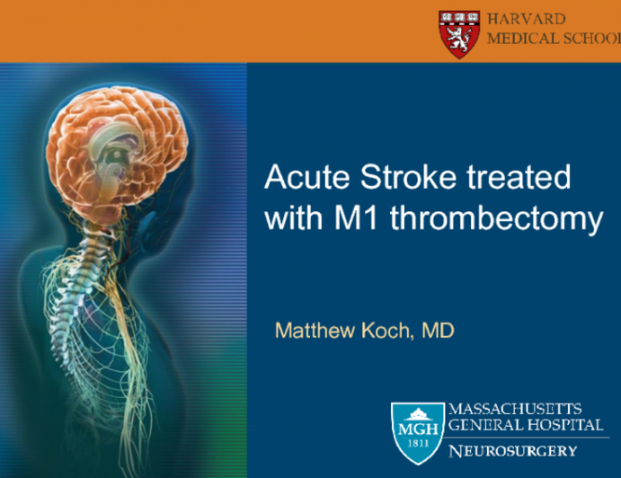 Case #1: Acute Stroke Treated With M1 Middle Cerebral Artery Thrombectomy