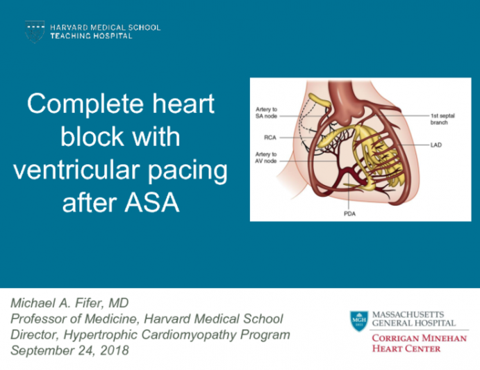 Case #3: Third-Degree AV Block After Ablation Requiring Upgrade from VVI to Dual Chamber Pacing