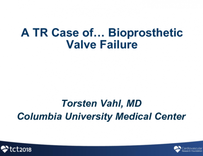 Case Presentation: A TR Case of… Bioprosthetic Valve Failure