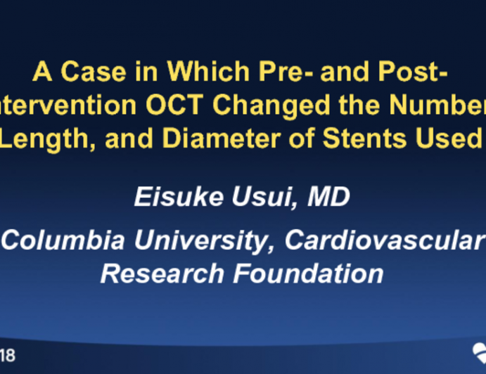 Case #2: A Case in Which Pre- and Post-interventional OCT Changed the Number, Length and/or Diameters of Stents Used