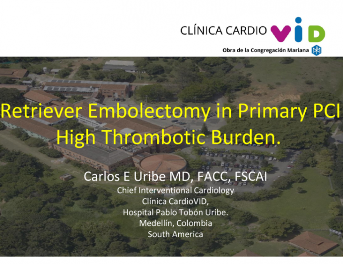 Interventional Innovation Highlights: Stent Retriever Embolectomy in Primary PCI With High Thrombotic Burden