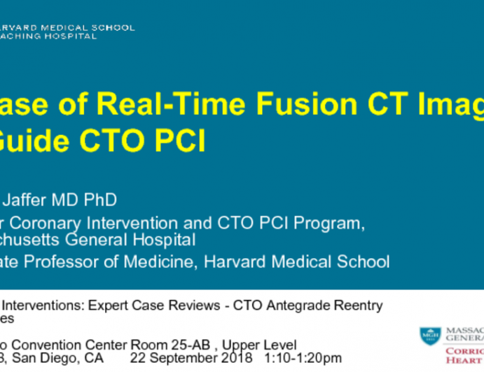 Case #6: A Case of Real-Time Fusion CT Imaging to Guide CTO PCI