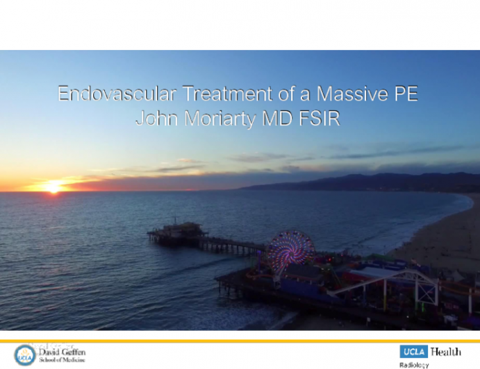 Case Presentation: Endovascular Treatment of a Massive Pulmonary Embolism