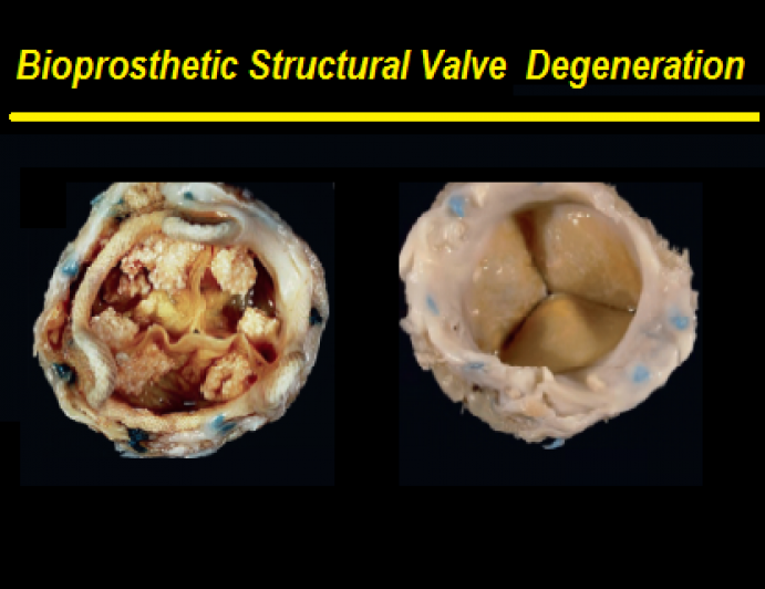Bioprosthetic structural valve degeneration