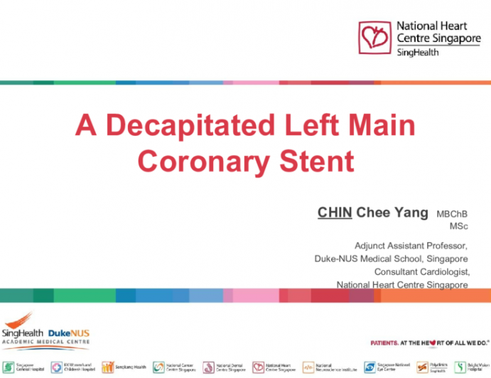 A Decapitated Left Main Coronary Stent