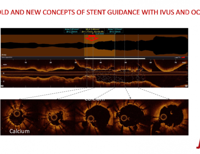 OLD AND NEW CONCEPTS OF STENT GUIDANCE WITH IVUS AND OCT