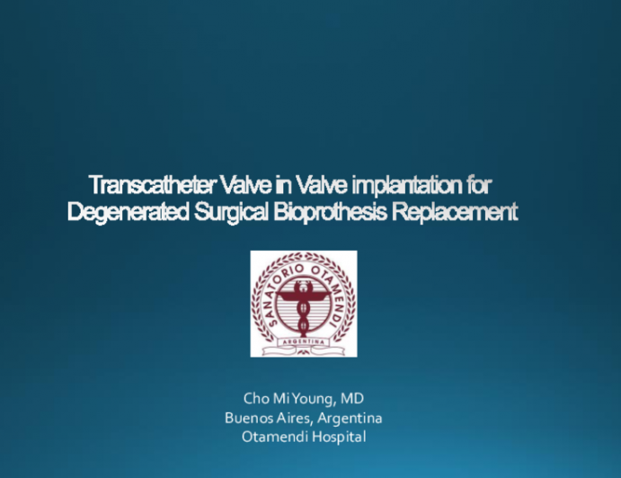 Transcatheter Valve in Valve implantation for Degenerated Surgical Bioprothesis Replacement