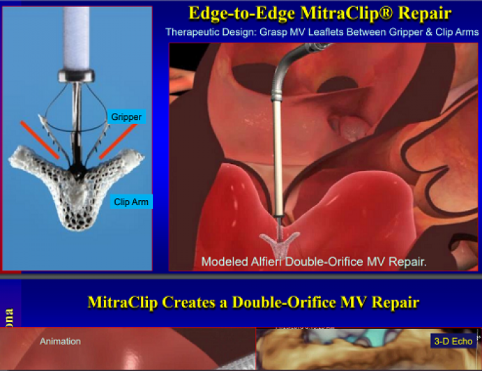 percutaneous mitral valve replacement