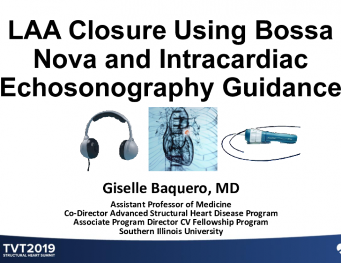 LAA Closure in a Completely Awake Patient Using BossaNova and Intracardiac Echosonography Guidance