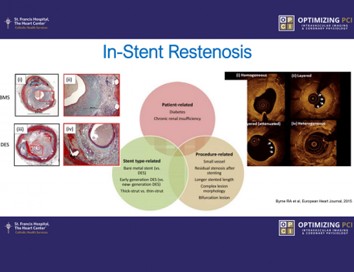 Stent failures – Identifying causes of stent thrombosis and restenosis and how to fix it