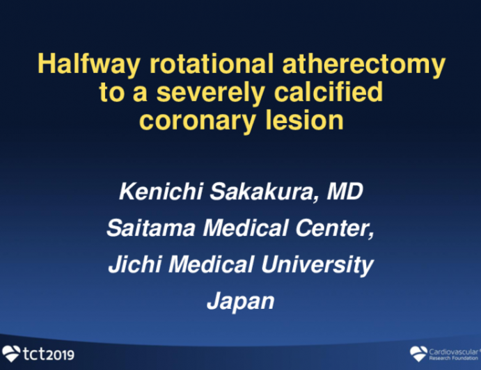 Halfway Rotational Atherectomy in Severely Calcified Coronary Lesions