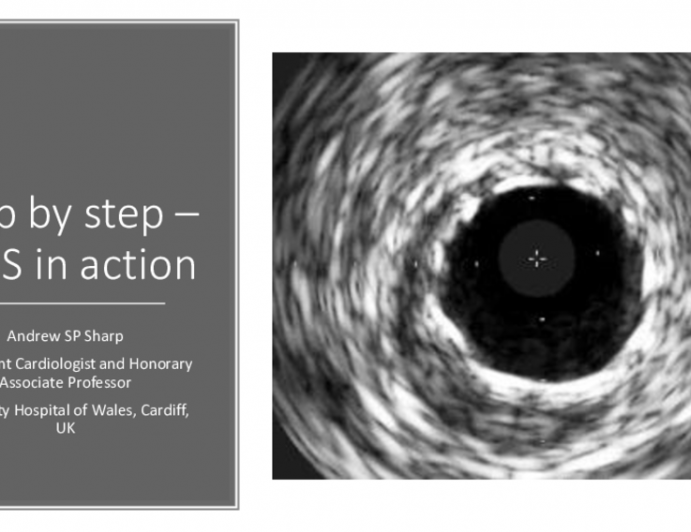 Step-by-Step IVUS: From Pre-Intervention Through Stent Optimization to Assessment of Complications