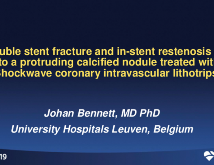 Belgium Presents: Double Stent Fracture and In-Stent Restenosis Due to a Protruding Calcified Nodule Treated With Shockwave Coronary Intravascular Lithotripsy