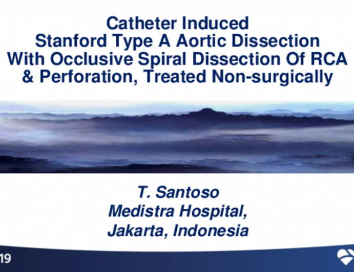 Indonesia Presents: Catheter Induced Stanford Type A Aortic Dissection With Occlusive Spiral Dissection of RCA and Perforation, Treated Non-Surgically