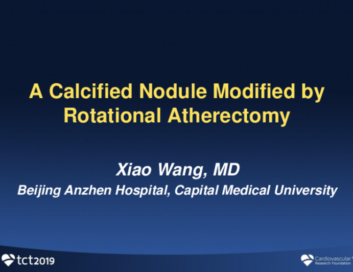 A Calcified Nodule Modified by Rotational Atherectomy