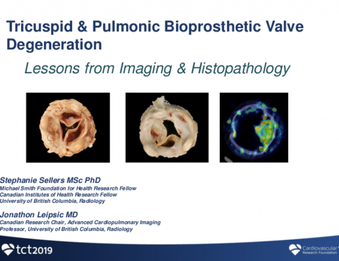 TCT 96: Tricuspid Valve-in-Valve and Bioprosthetic Surgical Tricuspid and Pulmonic Valve Degeneration: Lessons from Imaging and Histopathology