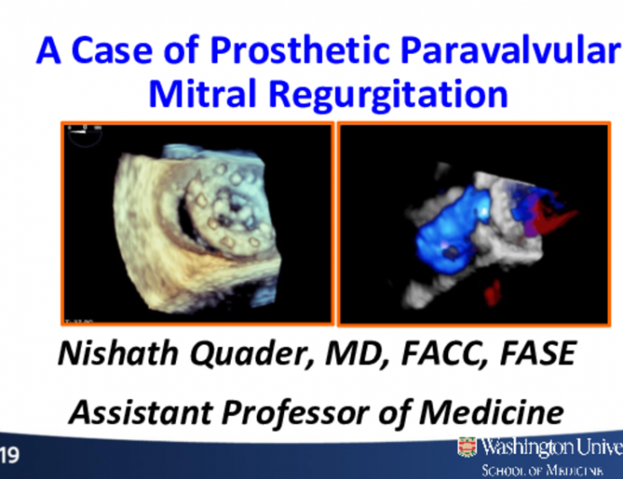 Case-Based Learning: Paravalvular Mitral Prosthetic Regurgitation