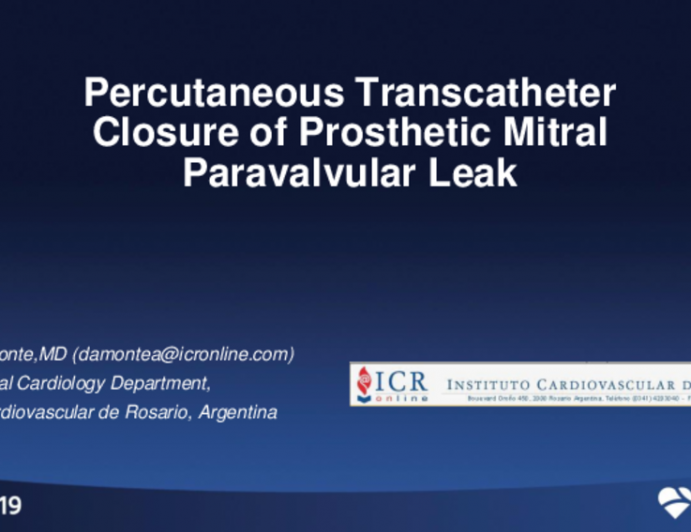 Argentina Presents: Percutaneous Transcatheter Closure of Prosthetic Mitral Paravalvular Leak
