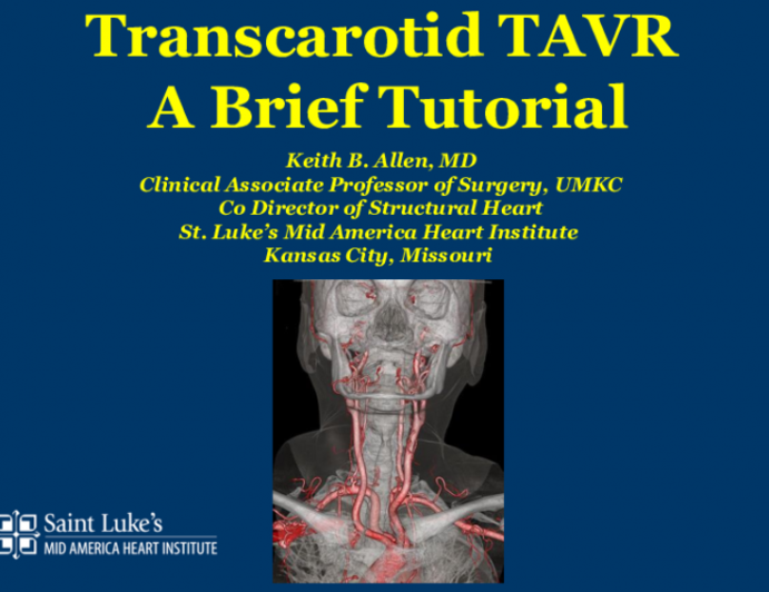When Transfemoral Is NOT an Option for TAVR, I Prefer... - Open Transcarotid TAVR: A Brief Tutorial
