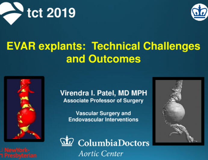 EVAR Explants: Technical Challenges and Outcomes