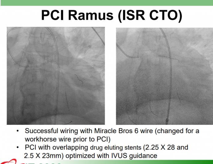 Left Main PCI with Co-Morbidities A New Zero Contrast Approach