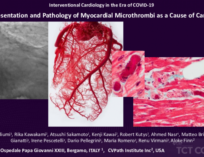 COVID-19: Clinical Presentation and Pathology of Myocardial MIcrothrombi as a Cause of Cardiac Injury