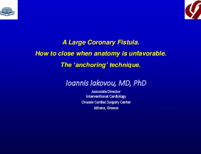 TCT 515: A Large Coronary Fistula. How to Close When Anatomy is Unfavorable. The ‘Anchoring’ Technique