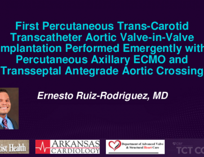 TCT 543: First Percutaneous Trans-Carotid Transcatheter Aortic Valve-in-Valve Implantation Performed Emergently With Percutaneous Axillary Extracorporeal Membrane Oxygenation Life Support and Transseptal Antegrade Aortic Crossing