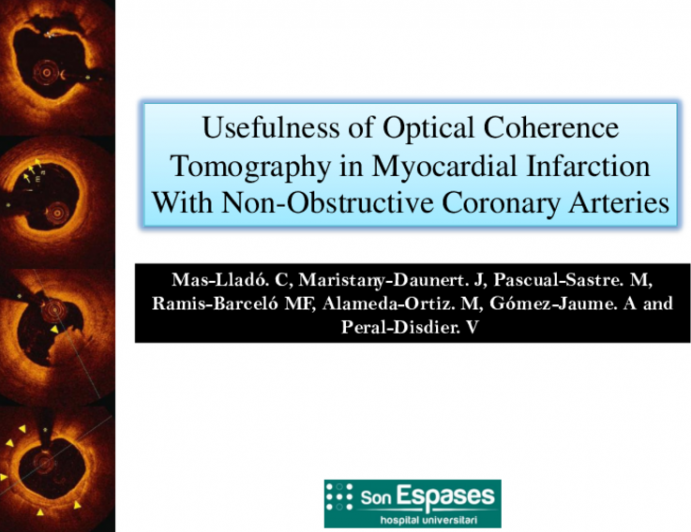 TCT 325: Usefulness of Optical Coherence Tomography in Myocardial Infarction With Non-Obstructive Coronary Arteries