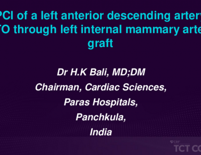 TCT 659: PCI of a Left Anterior Descending Artery CTO Through Left Internal Mammary Artery Graft