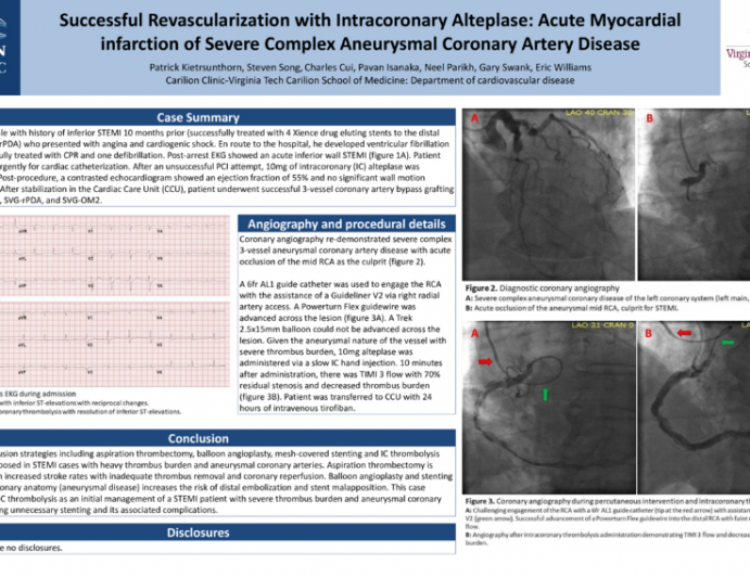 TCT 638: Successful Revascularization with Intracoronary Alteplase: Acute Myocardial infarction of Severe Complex Aneurysmal Coronary Artery Disease