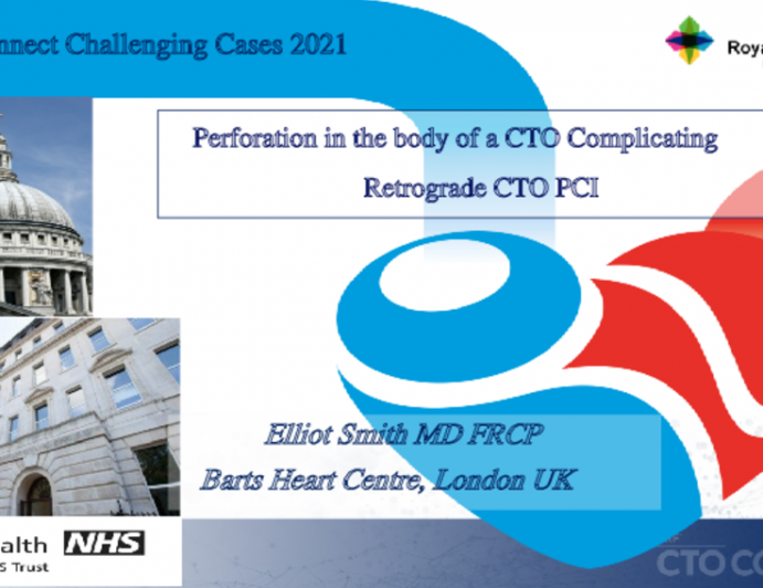 Perforation in the body of a CTO Complicating Retrograde CTO PCI 