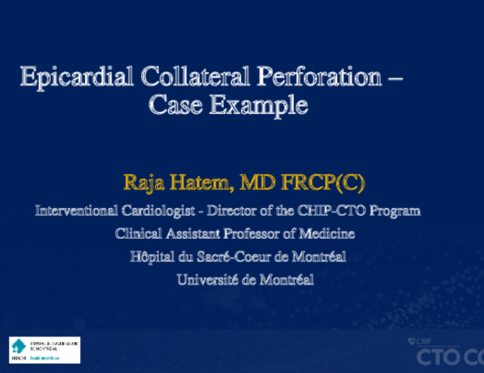 Epicardial Collateral Perforation – Case Example