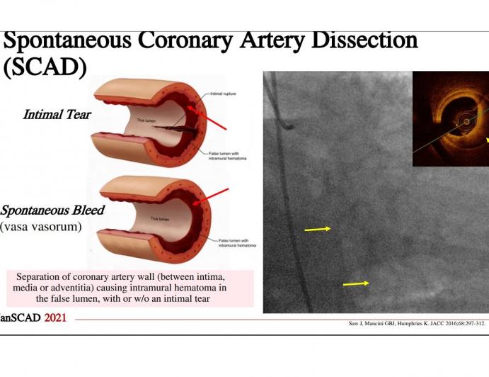 Diagnosis of SCAD on Coronary Angiography